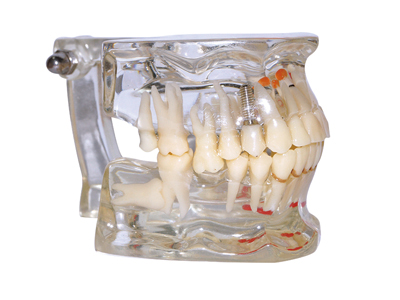 HST-C2  Edentulous Pathology Model 