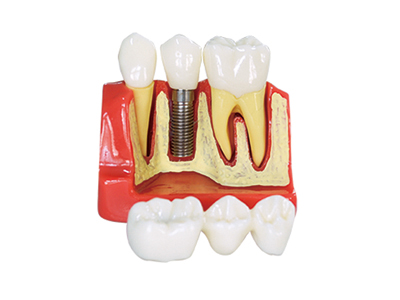 HST-M3 4Times Implant Model